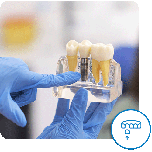 Implantologia dental vid